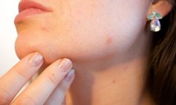 Maske cilt sorunlarını tetikliyor