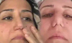 Böylesi görülmedi! Burun estetiği yaptırmak istedi şok üstüne şok yaşadı! "Bir yere gidince millet bana bakıyor"