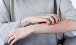 Lupus nedir? Belirtileri nelerdir?