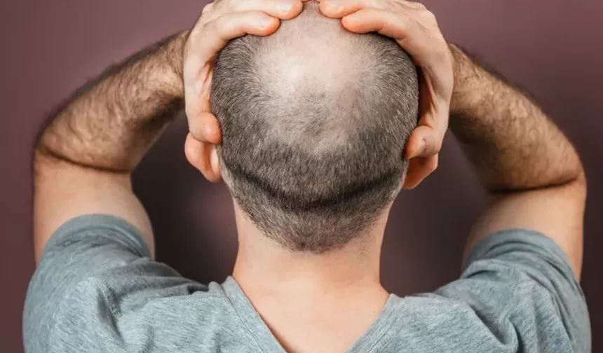 Hormonal Değişiklikler: Erkeklerde testosteron hormonu, saç büyümesi ve dökülmesi üzerinde etkilidir. DHT (dihidrotestosteron) adı verilen bir hormon, saç foliküllerini zayıflatır ve incelme ve dökülme sürecini hızlandırabilir. Bazı erkeklerde, saç foliküllerinin DHT'ye olan hassasiyeti daha yüksek olabilir, bu da kellik riskini artırır.