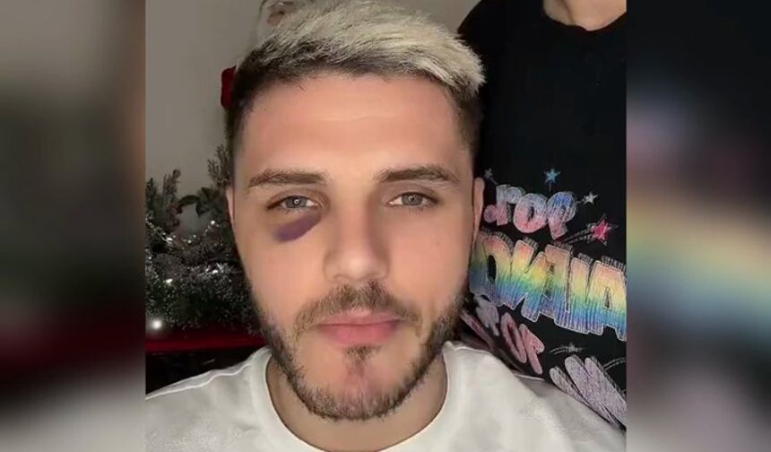 Wanda Icardi'ye makyajı yaptı, morluğu yok etti!