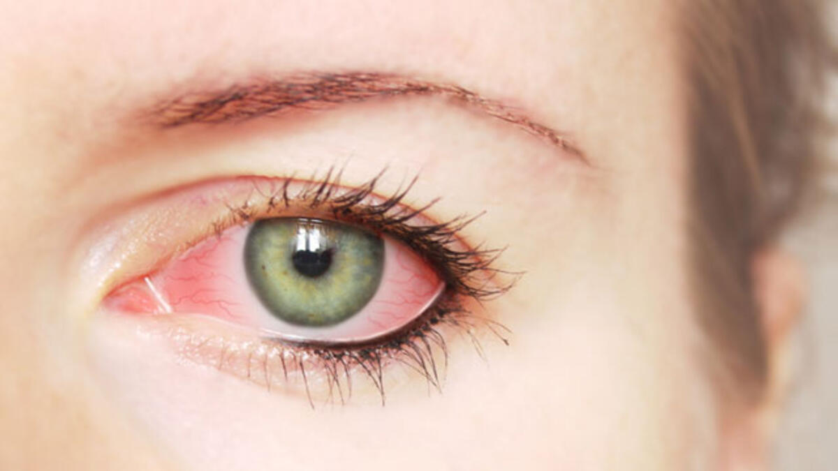 Göz Tansiyonu Hastalığı (GLOKOM) – İzmir Göz Doktoru