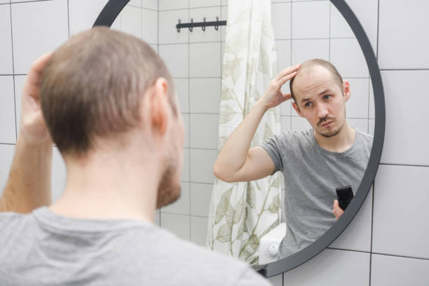
Genetik Yatkınlık: Kalıtımsal faktörler, erkeklerin kellik riskini artırabilir. Genellikle androjenetik alopesi olarak bilinen erkek tipi kellik, ailesel geçiş gösterebilir. Bu durum, saç foliküllerinin zamanla küçülmesi ve saçın giderek incelmesiyle karakterizedir.